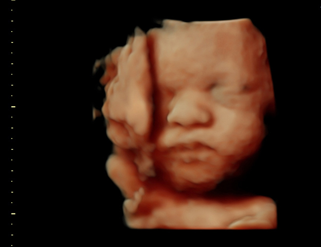 3D ultrasound image at 31 weeks